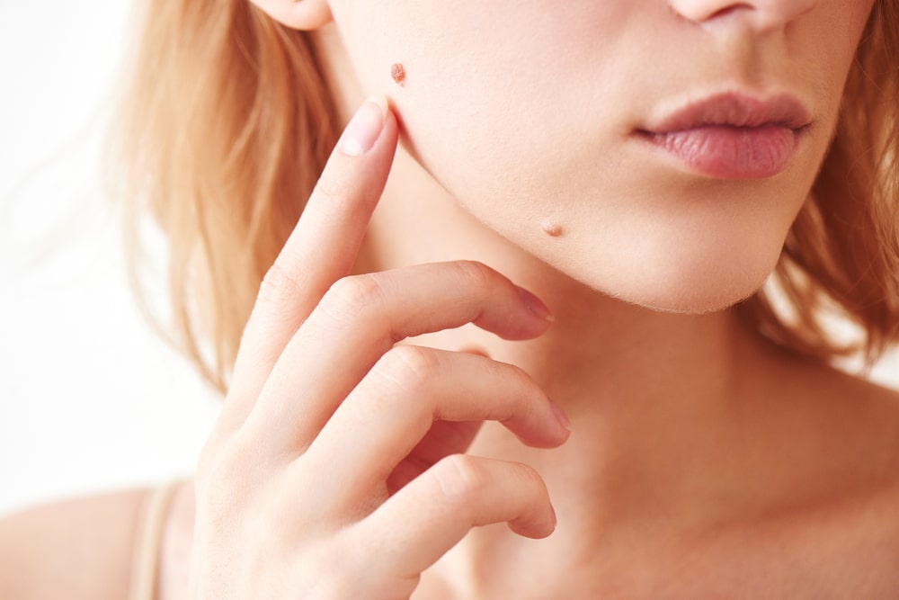 Mole, Wart & Skin Tag Removal.jpg